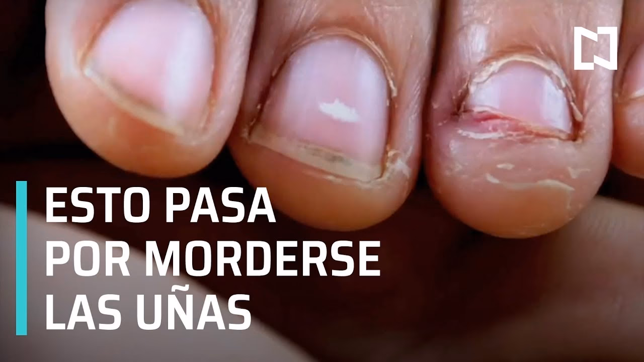 ¿Cuando te muerdes las uñas, ¿qué reflejas con esa expresión?